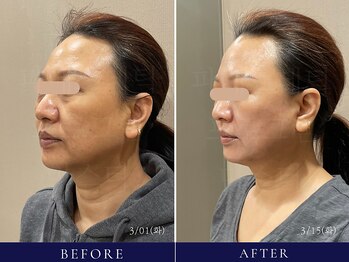 フローラル ビューティー(Floral-Beauty)/【ビフォーアフター】小顔エステ