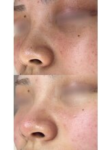 アトリーチェ ベレッツァ(ATTRICE Bellezza)/毛穴洗浄×マーメイド