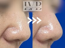 ラヴレボーテ(La Vraie Beaute)の雰囲気（加工なし、当サロンの毛穴ケア改善症例・毛穴黒ずみ/毛穴洗浄）