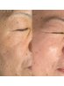 平日限定【12時~17時】低周波/シミ・くすみ・乾燥/お悩み解決シミケア7800円