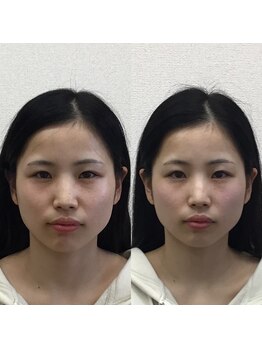 オズ六本木/六本木小顔矯正(造顔)施術1回