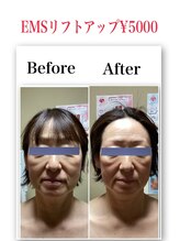 ブリリアント(Brilliant)/EMSリフトアップコース！