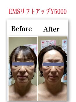 ブリリアント(Brilliant)/EMSリフトアップコース!