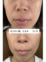 ジューンブライド(June Bride 61)/肌改善プログラム