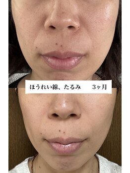 ジューンブライド(June Bride 61)/肌改善プログラム