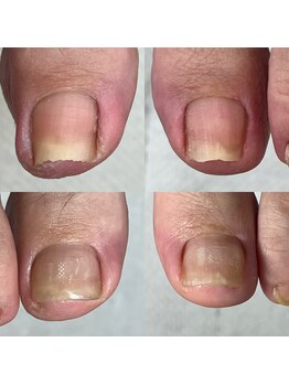 ランランネイル(rangrang nail)/巻き爪補正