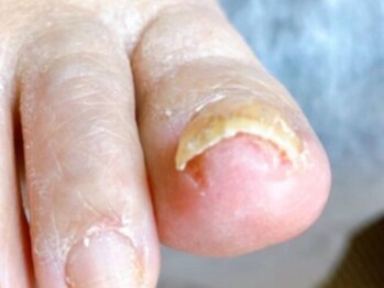 名古屋駅前巻き爪センターの写真/分厚い爪・深爪・変色爪でお悩みの方へ◎なかなか改善しなかったお悩みは豊富な経験と技術で改善!