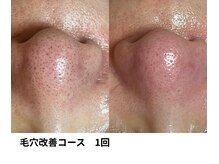 ボニータ(Bonita)/毛穴エクストラクション