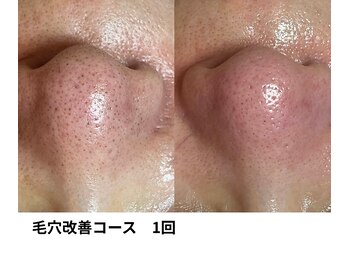 ボニータ(Bonita)/毛穴エクストラクション