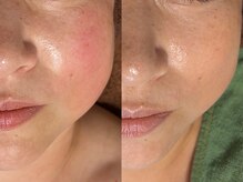 サロン ド エン(Salon de. en)の雰囲気（長年お悩みの肌荒れのケア×ハーブピーリング【金山/名古屋】）