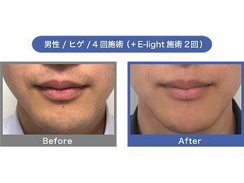 バランス鍼灸整骨院/ヒゲ脱毛　ビフォーアフター