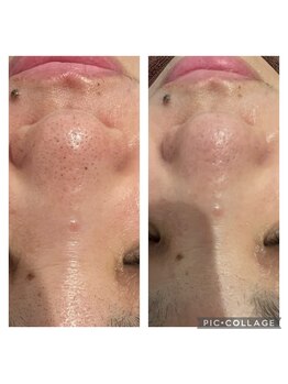 トータルエステティックサロン ラ レーヌ(La Reine)/ハイドラで毛穴悩みをサポート