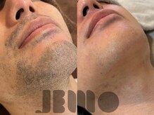 ジェモ(JEMO)の雰囲気（【メンズヒゲ脱毛】before/after（10回）好きな形に整える！）
