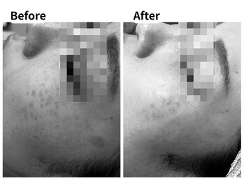 ムーロ バイ ミュー(muro. by mieux)/Before After