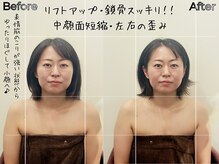 リストアハート(Restore Heart)/中顔面短縮・左右差の歪み解消