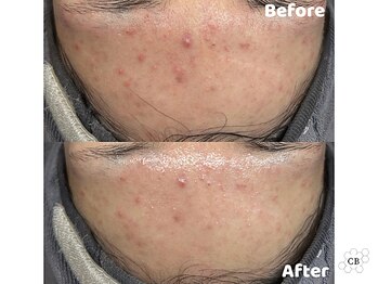 クリスタルビューティ 渋谷/NEW【韓国ミルクスキンピール】