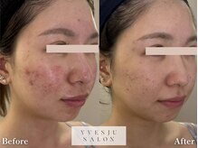 イヴジュ サロン(YVESJU SALON)の雰囲気（自社開発マシンでの肌質改善ケア。フェイシャルでのお悩みも◎）