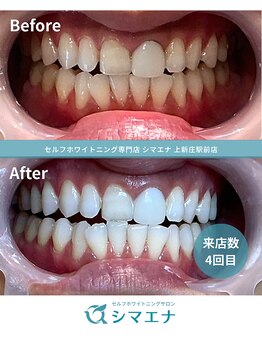 シマエナ 上新庄駅前店/ビフォーアフターホワイトニング