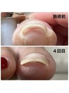 巻き爪ケア