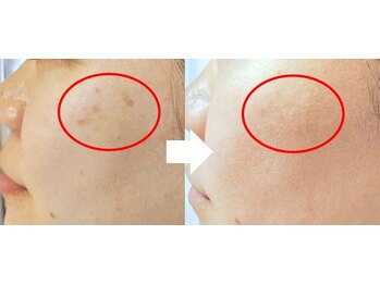 リセル(RE.cell)/シミケア3回後