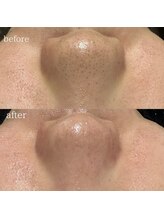 リメレ(Rimere)/毛穴洗浄×プラズマ微細針