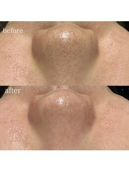 リメレ(Rimere)/毛穴洗浄×プラズマ微細針