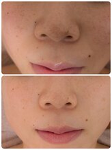 プライベートサロン 美月/3回施術で透明感！毛穴レス！