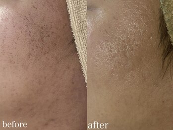 ホワイトアクア 北千住店(WHITE AQUA)/ハーブピーリング2回/ニキビケア