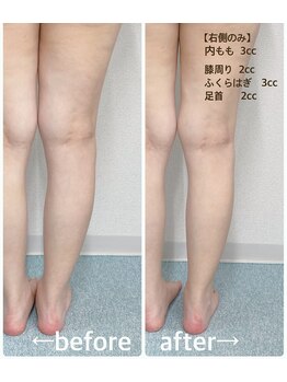 ハロ 南青山(HALO)/レモンボトル☆1回