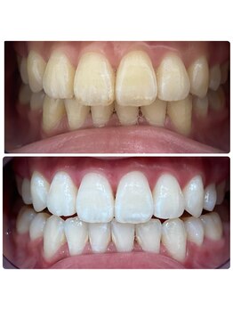 エクシアホワイトニング 日本橋店/6ヶ月経過!