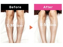 エモーションプラス(Emotion plus)/八王子メンズ脱毛|before・after