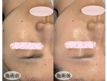 ストーリー(STORY)/眉毛と艶肌ワックス専門店