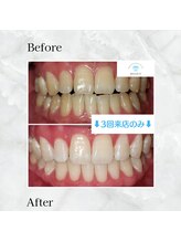 ホワイトニングサロンリセット 白金高輪(RESET)/3回の効果で笑顔が明るく！