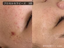 ジュパール(je pars)/プロセルセラピーズ
