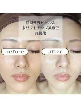 ゼニス 池袋本店(ZENITH)/美白もツヤも透明感も小顔も☆