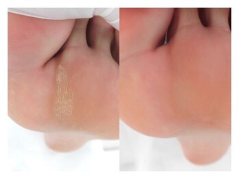 巻き爪ケアサポート ルアナ(LUANA)/Before→After