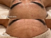 シャルム(Charme)/メンズフェイシャル♪シワケア