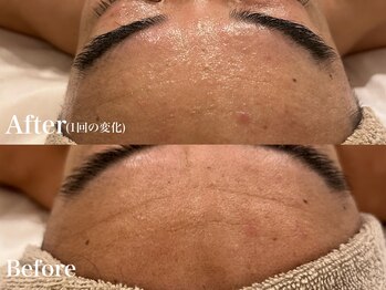 シャルム(Charme)/メンズフェイシャル♪シワケア