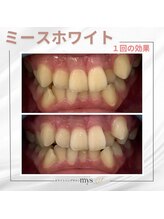 ミースホワイトニング(mys whitening)/ビフォーアフター【歯科提携】
