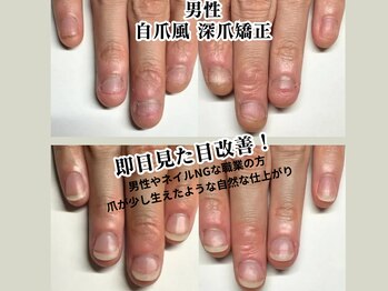クウ(KUU)/男性深爪矯正 自爪風