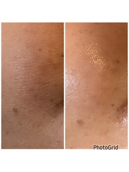 ピュアプラス(Pure Plus)/Hydra Reborn Luxe 