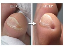 巻き爪補正店 大曽根店/副爪