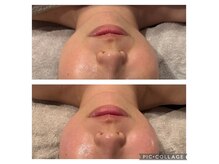 ザ サロン バイ スロウ(the Salon by SLOW)の雰囲気（小顔フェイシャル1回の結果）