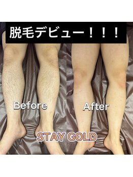 ステイゴールド 新百合ヶ丘(STAY GOLD)/剃るなら脱毛を!
