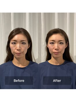 美容整体プラスフィール 恵比寿本店/小顔・顔の左右差・リフトアップ