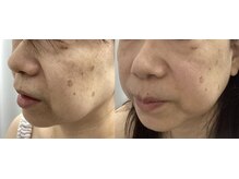 ルボン(RUBON)/　たるみケア・毛穴の開き