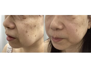 ルボン(RUBON)/　たるみケア・毛穴の開き