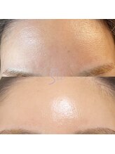 レアスキン(Rare skin.)/水光生美容液導入トリートメント