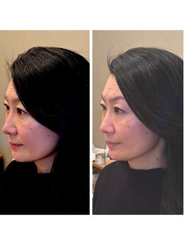 グレース 江坂(GRACE)/50歳女性 たるみ/小顔