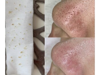 イリス(Iris)/Iris式毛穴エクストラクション